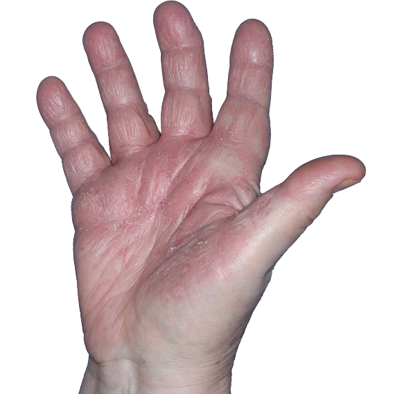 Case 2: At Baseline, patient has scaling and erythema. iGA-CHE score: 4. HESD-Itch score: 5.1. HESD-Pain score: 4.7