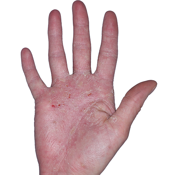 Case 4: At Baseline, patient has erythema, scaling, and eroisions. IGA-CHE score: 4. HESD-Itch score: 5.9. HESD-Pain score: 9