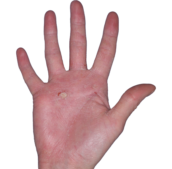 Case 4, Week 4: IGA-CHE score: 3. HESD-Itch score: 4.1. HESD-Pain score: 4