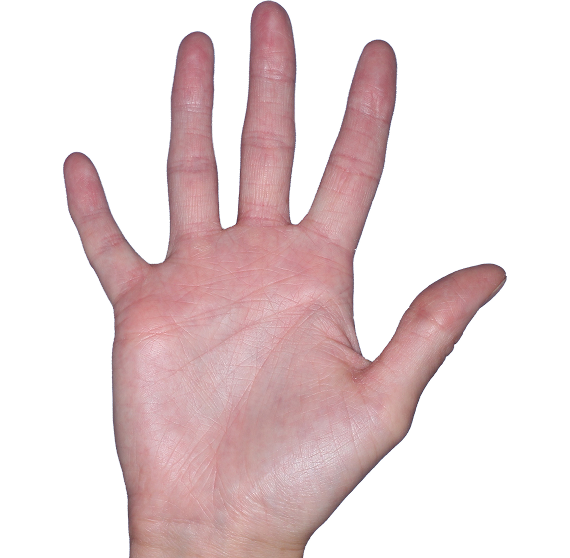 Case 4, Week 16: IGA-CHE score: 1. HESD-Itch score: 1.4. HESD-Pain score: 1.3
